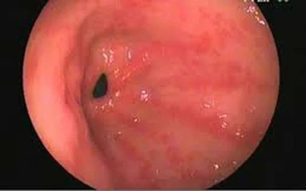 Cấp độ 1 của viêm loét dạ dày: Viêm xung huyết hoặc trợt dạ dày