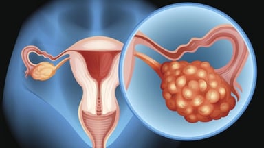 Tìm hiểu về xét nghiệm tầm soát ung thư buồng trứng