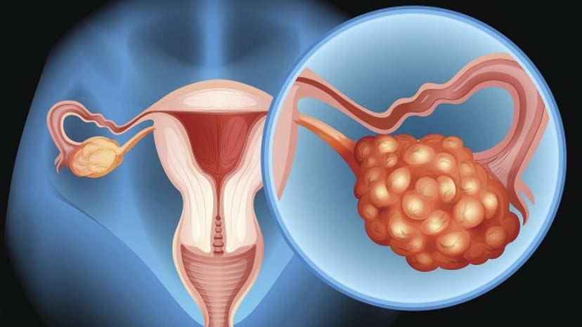 Tìm hiểu về xét nghiệm tầm soát ung thư buồng trứng