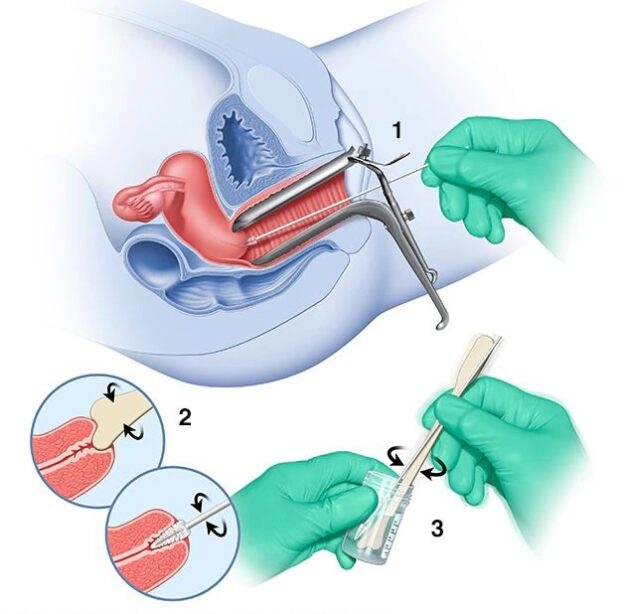 Quy trình thực hiện xét nghiệm PAP Smear