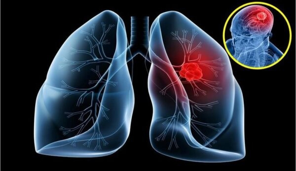 Ung thư phổi khi di căn khái niệm