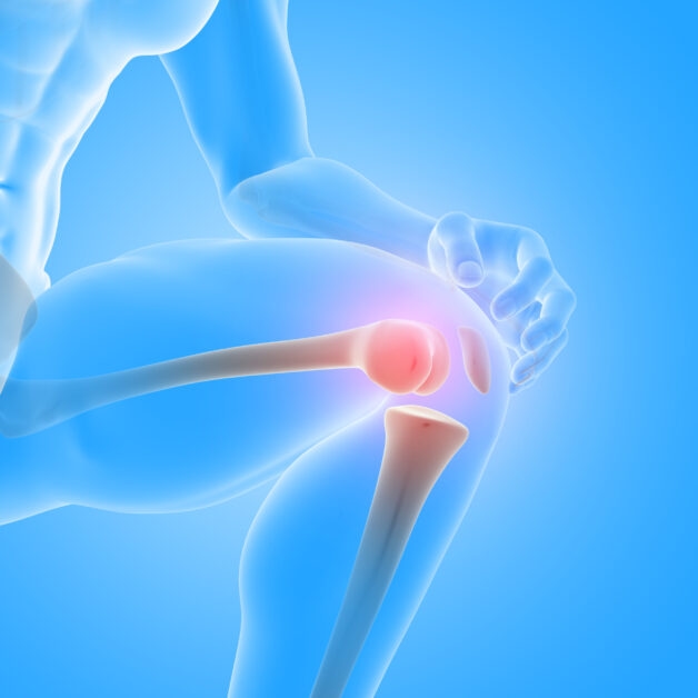 Thoái hóa khớp gối gây đau nhức