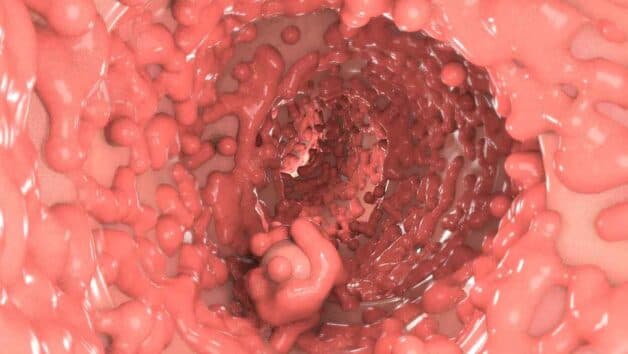 Chữa bệnh đa polyp đại tràng giảm nguy cơ tiến triển ung thư