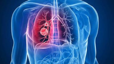 Khám tầm soát ung thư phổi ở đâu hiệu quả và chính xác?