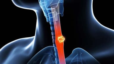 Làm rõ các phương pháp xét nghiệm ung thư thực quản