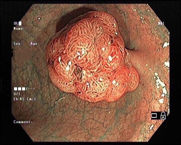 Hình ảnh nội soi khối polyp đại tràng.
