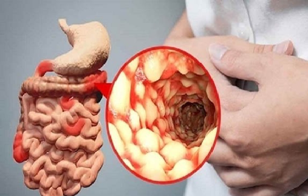 Chỉ định nội soi vùng đại tràng bằng phương pháp gây mê