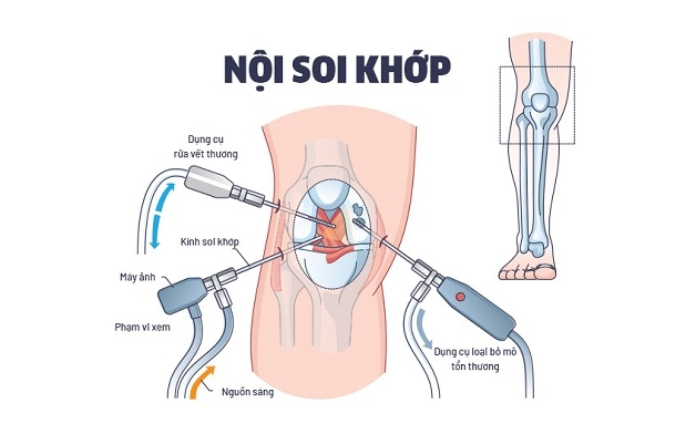 nội soi khớp gối