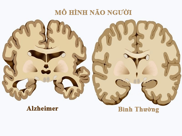 chẩn đoán hình ảnh alzheimer