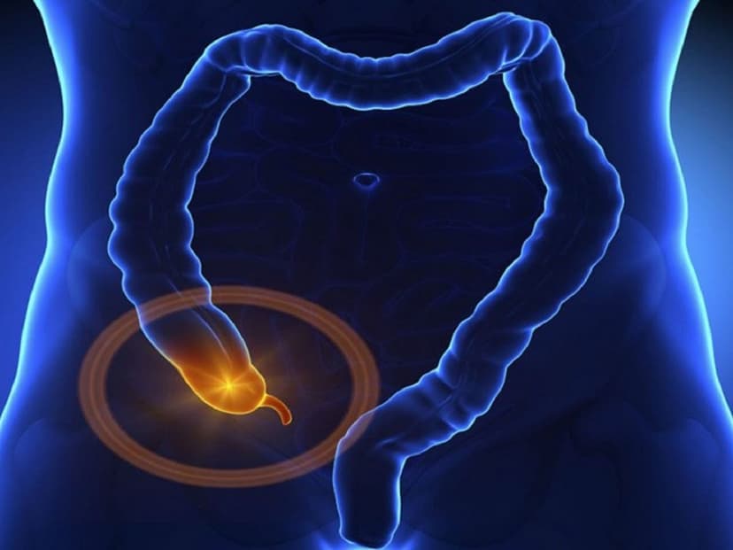 Các triệu chứng bị đau ruột thừa cần chú ý