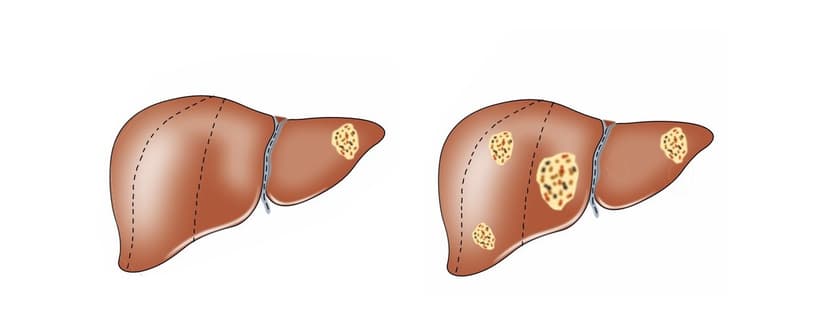 Thông tin quan trọng về ung thư gan di căn ổ bụng