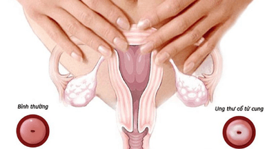 4 phương pháp giúp phát hiện ung thư cổ tử cung