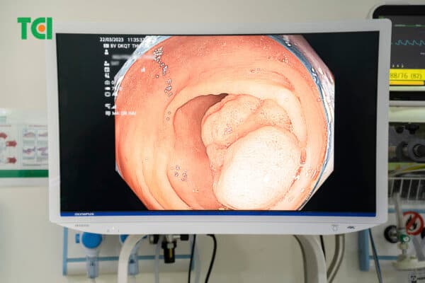 Hình ảnh polyp đại tràng lớn qua nội soi