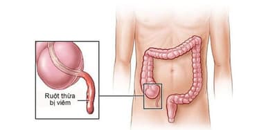 Triệu chứng viêm ruột thừa cấp là gì?