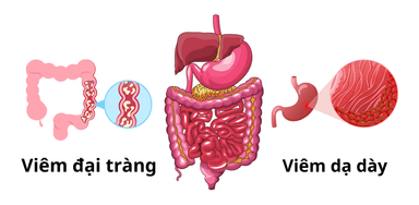 Cách phân biệt viêm đại tràng và dạ dày