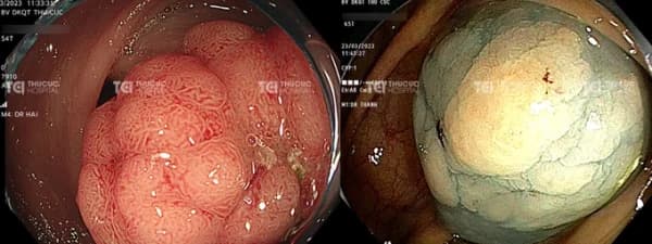 Polyp đại tràng chảy máu