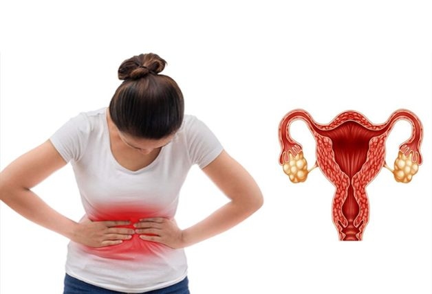 Hội chứng buồng trứng đa nang là một trong các nguyên nhân chính
