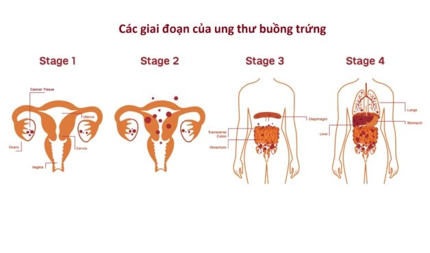 Giai đoạn và phương pháp điều trị ung thư tại buồng trứng