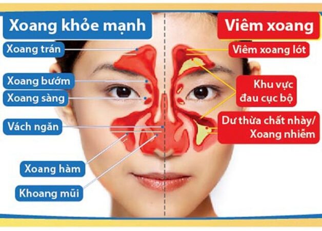 cách chữa bệnh viêm xoang mãn tính