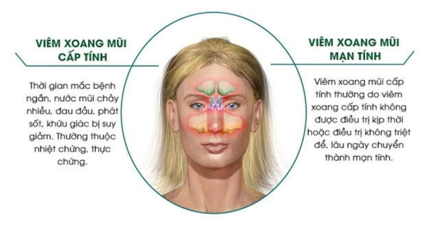 Điều trị viêm xoang mãn tính