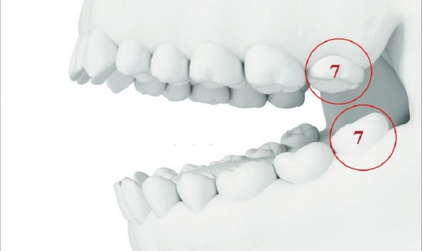 Có cần trồng lại nếu mất răng số 7 không?
