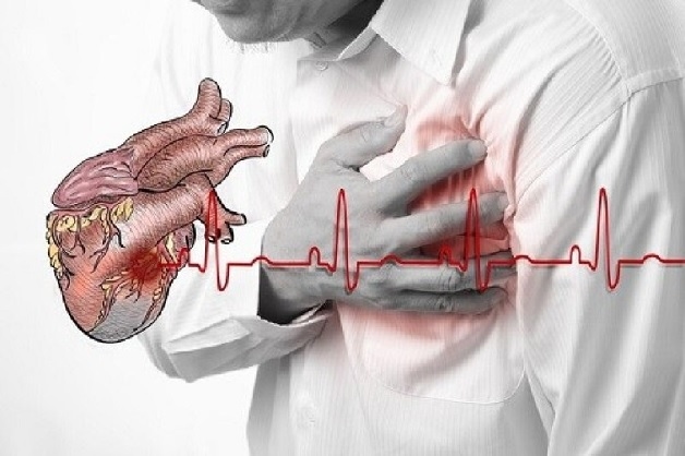 Nhồi máu cơ tim là tình trạng tắc nghẽn mạch vành, gây thiếu máu cơ tim đột ngột