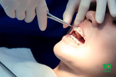 7 dấu hiệu nhận biết niềng răng bị hỏng