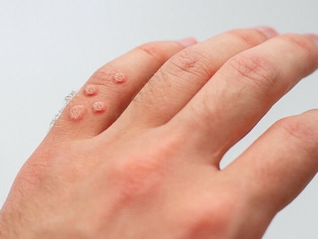 Virus HPV thường gây ra bệnh lây truyền qua đường tình dục, bao gồm quan hệ bằng đường miệng.