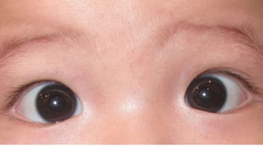 Trẻ bị lác trong: Phân loại và cách điều trị