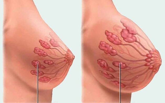 U sợi tuyến vú đa phần lành tính