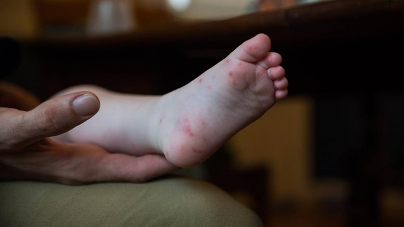 Bệnh tay chân miệng thường gặp ở lứa tuổi nào?