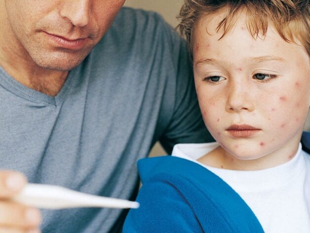 Dấu hiệu nhận biết thủy đậu điển hình là mụn nước mọc trên các ban đỏ.
