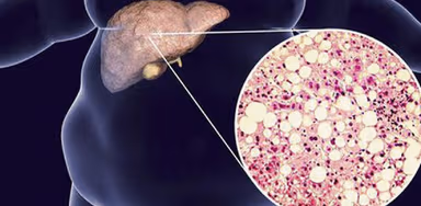 Mối liên hệ giữa gan nhiễm mỡ và tiểu đường