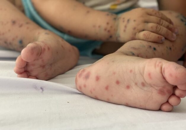 Hình ảnh bệnh tay chân miệng ở trẻ em.
