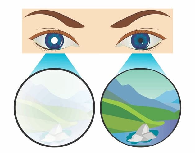 mắt bị lác trong