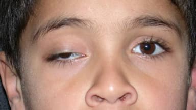 Mắt bị sụp mí khi ngủ dậy: Nguyên nhân và cách khắc phục