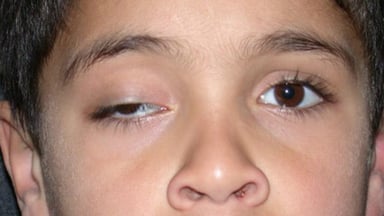 Mắt bị sụp mí khi ngủ dậy: Nguyên nhân và cách khắc phục