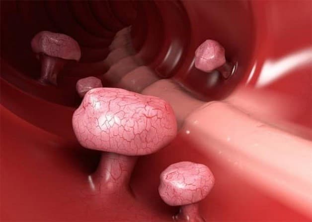 Polyp đại tràng là bệnh lý thường gặp ở hệ tiêu hóa