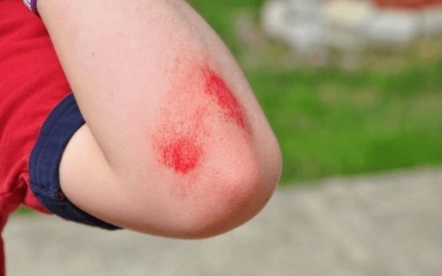 người có vết thương