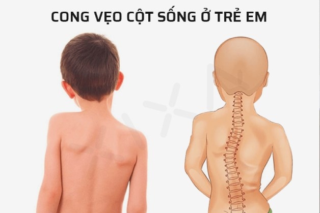 cong vẹo cột sống