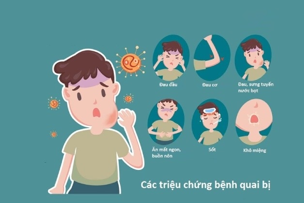 bệnh quai bị