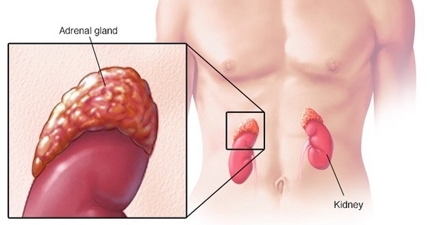 Điều trị bệnh ung thư tuyến thượng thận gặp nhiều khó khăn vì phát hiện muộn.