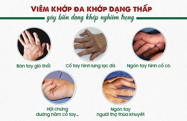 viêm khớp dạng thấp bệnh học