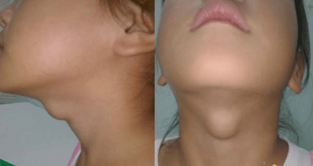 Sưng cổ là 1 trong 10 dấu hiệu tuyến giáp cần lưu ý