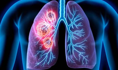 Giải đáp câu hỏi thường gặp về ung thư phổi di căn