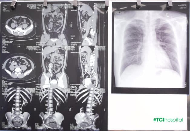 Giải cứu thận lạc chỗ hiếm gặp khỏi tình trạng sỏi gây tiểu máu