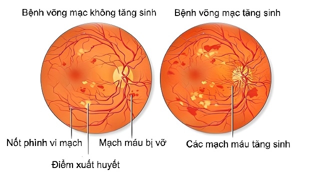 bệnh võng mạc tiểu đường không tăng sinh