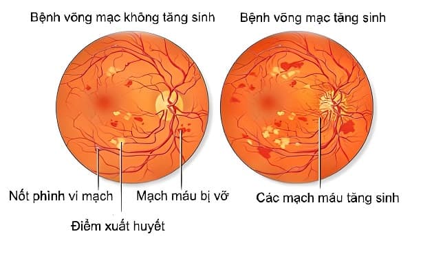 bệnh võng mạc tiểu đường không tăng sinh