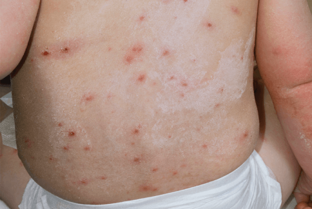 Mụn nước mọc trên nền các ban đỏ, tập trung thành cụm trên mặt và trên thân, tay chân.