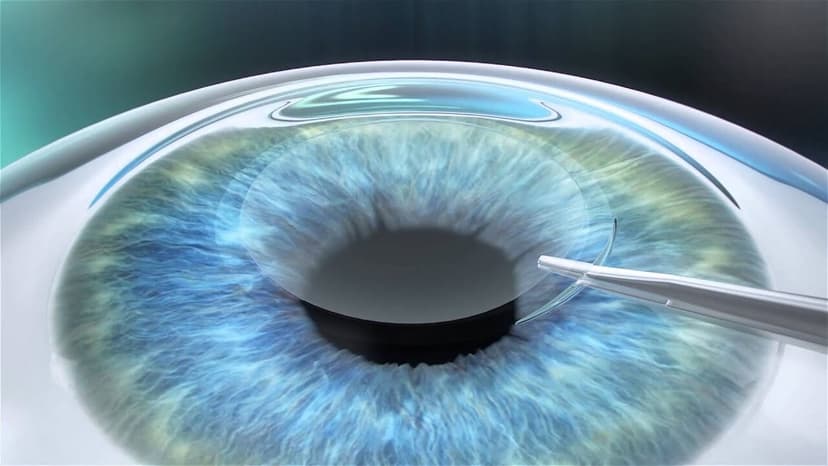 5 Điều cần biết về phẫu thuật tật khúc xạ smile